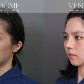 療程效果因人而異，上圖為該案例實際進行 FITme 完形美 客製化3D列印矽膠假體+取肋骨延長鼻中膈+雕鼻頭 之術後效果